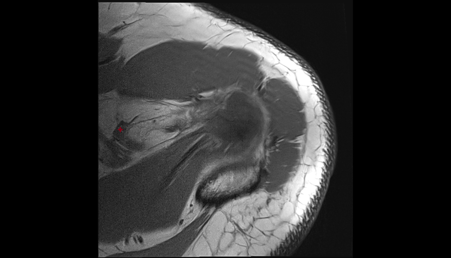 Conoid  ligament  axial cross sectional anatomy 3T MRI AI enhanced radiology image-img-00000-00000