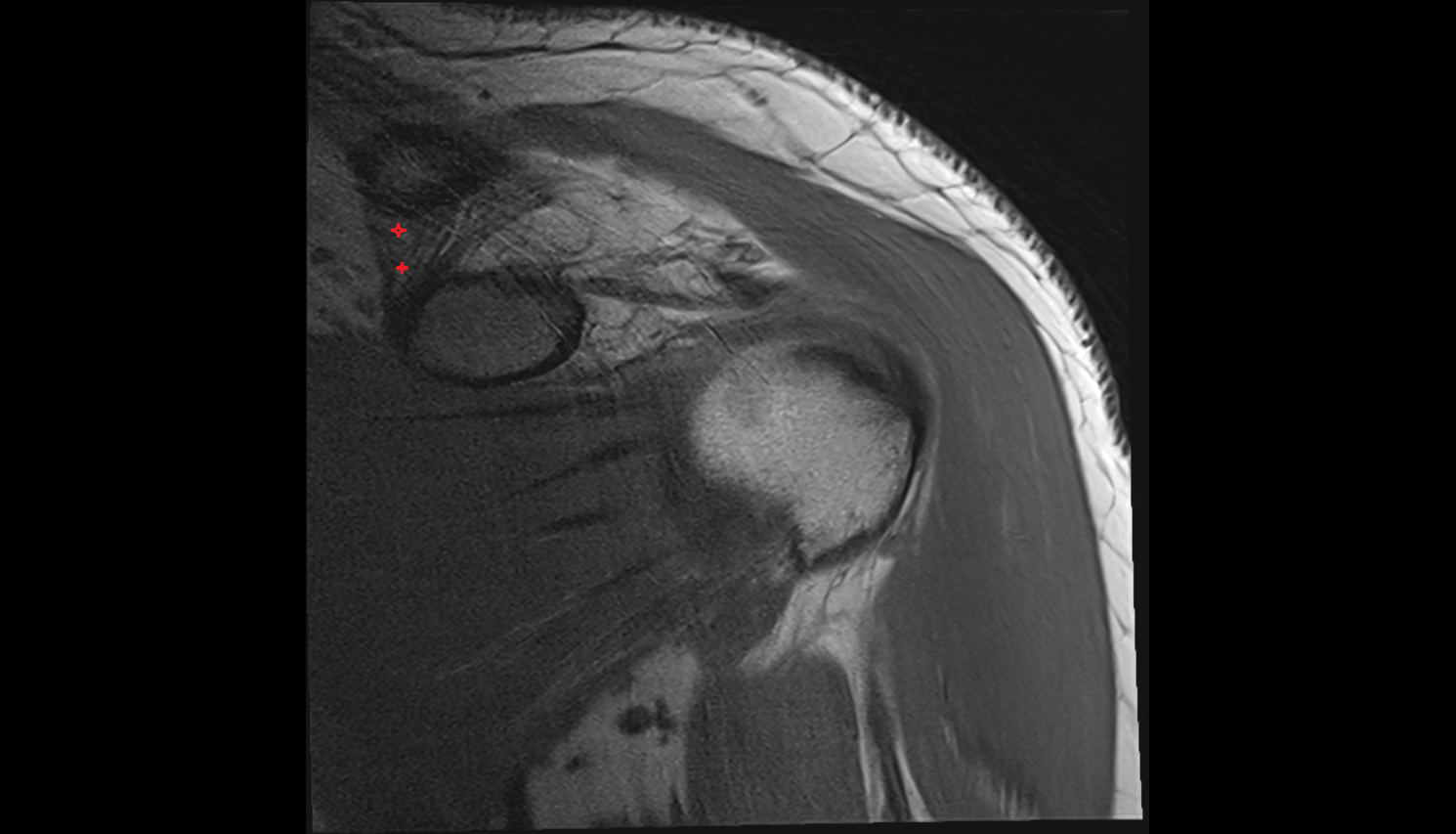 Conoid  ligament  coronal cross sectional anatomy 3T MRI AI enhanced radiology image-img-00000-00000