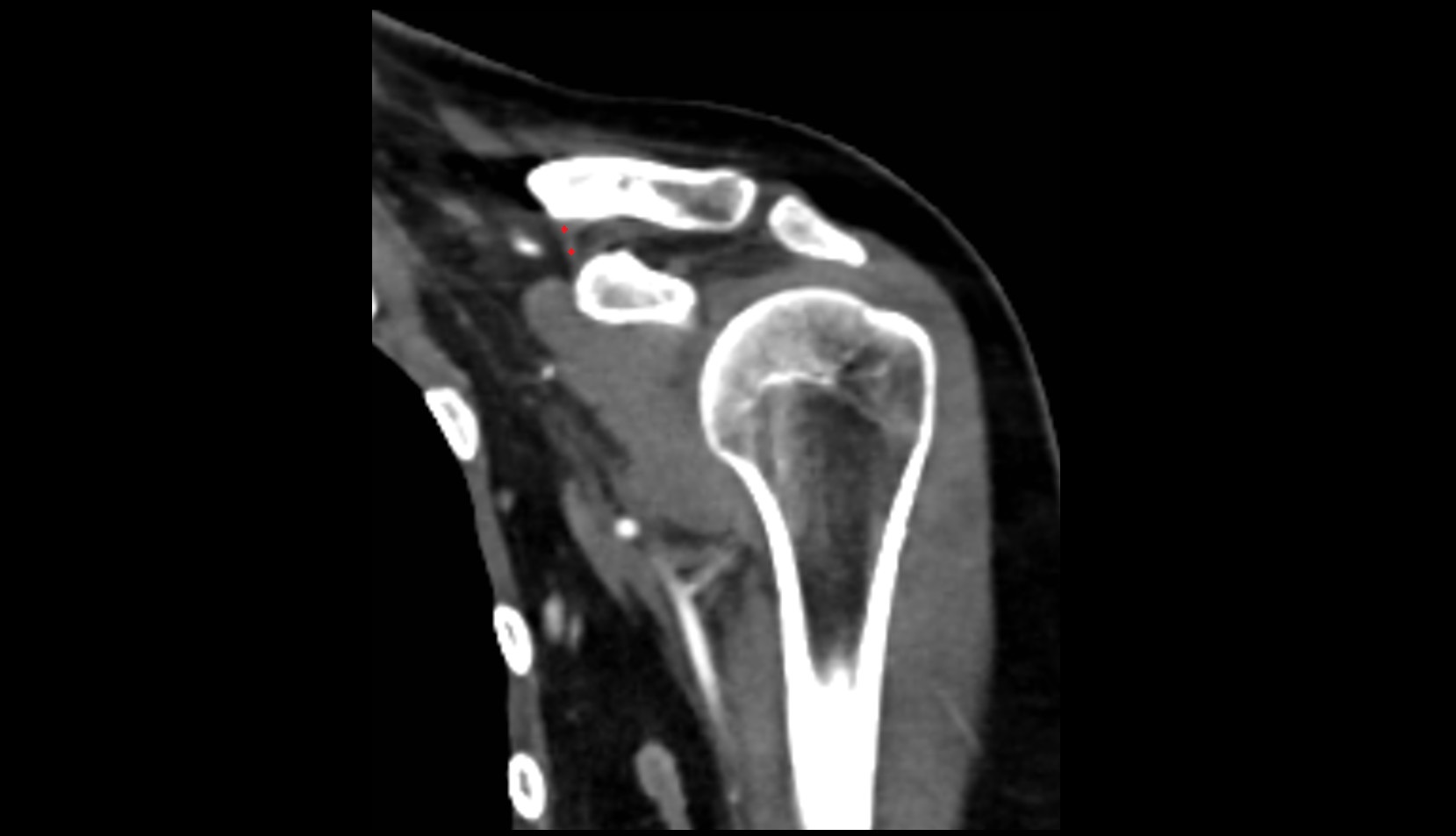 Conoid ligament ct coronal