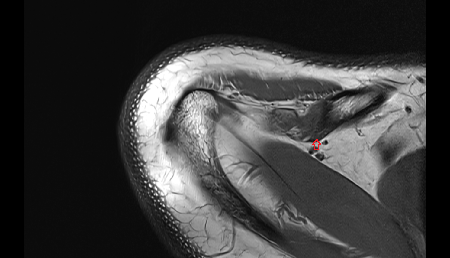 Conoid tubercle coronal cross sectional anatomy 3T MRI AI enhanced radiology image-img-00000-00000