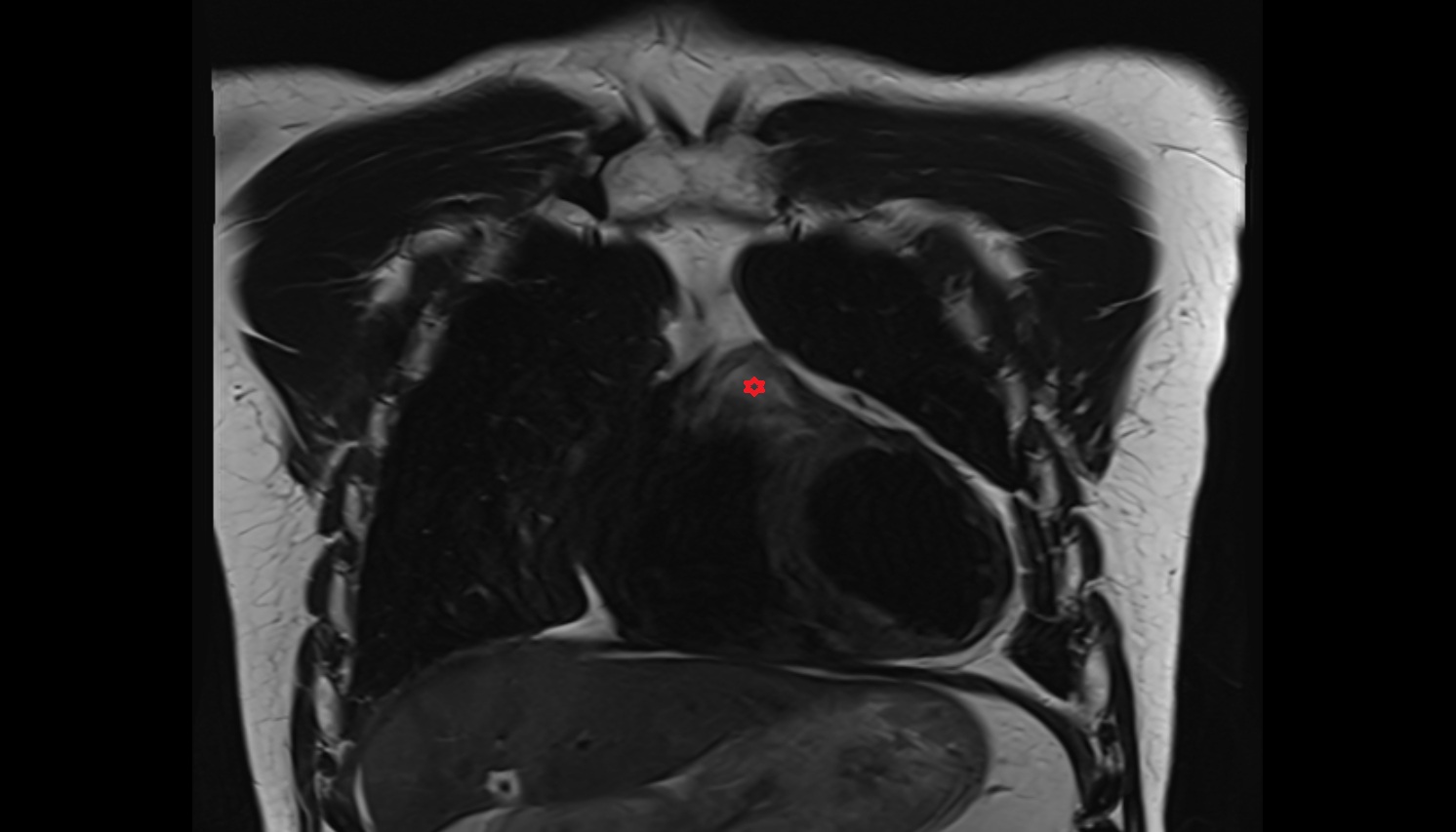 Conus arteriosus anatomy  MRI coronal  image -img-00000-00000