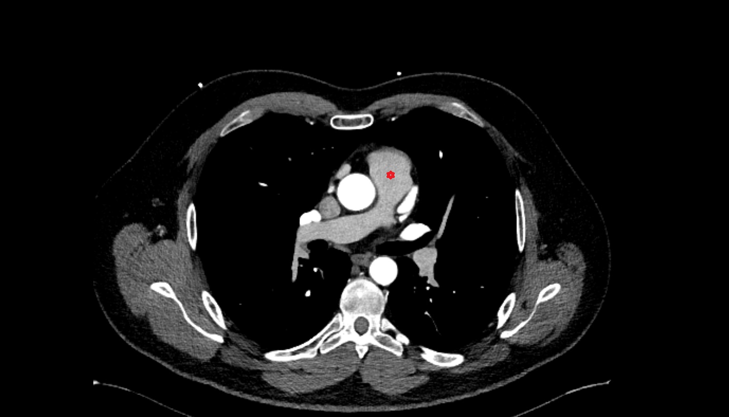 Conus arteriosus anatomy  ct axial  image -img-00000-00000