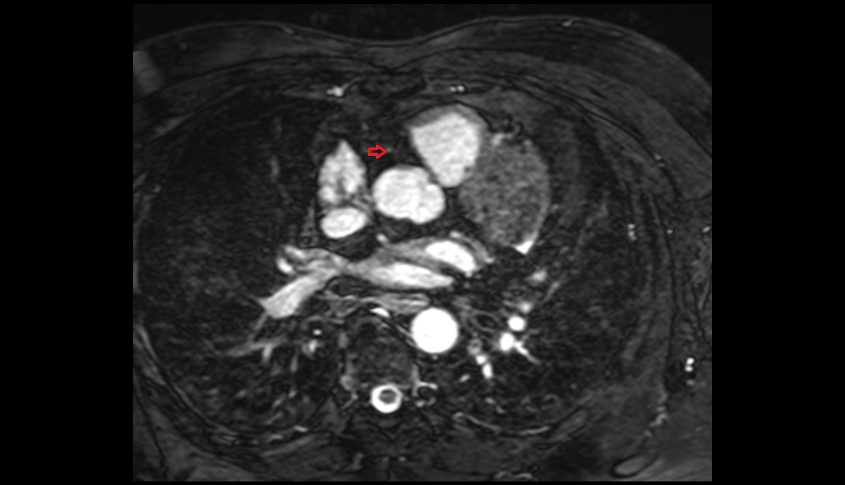 Conus artery mri axial