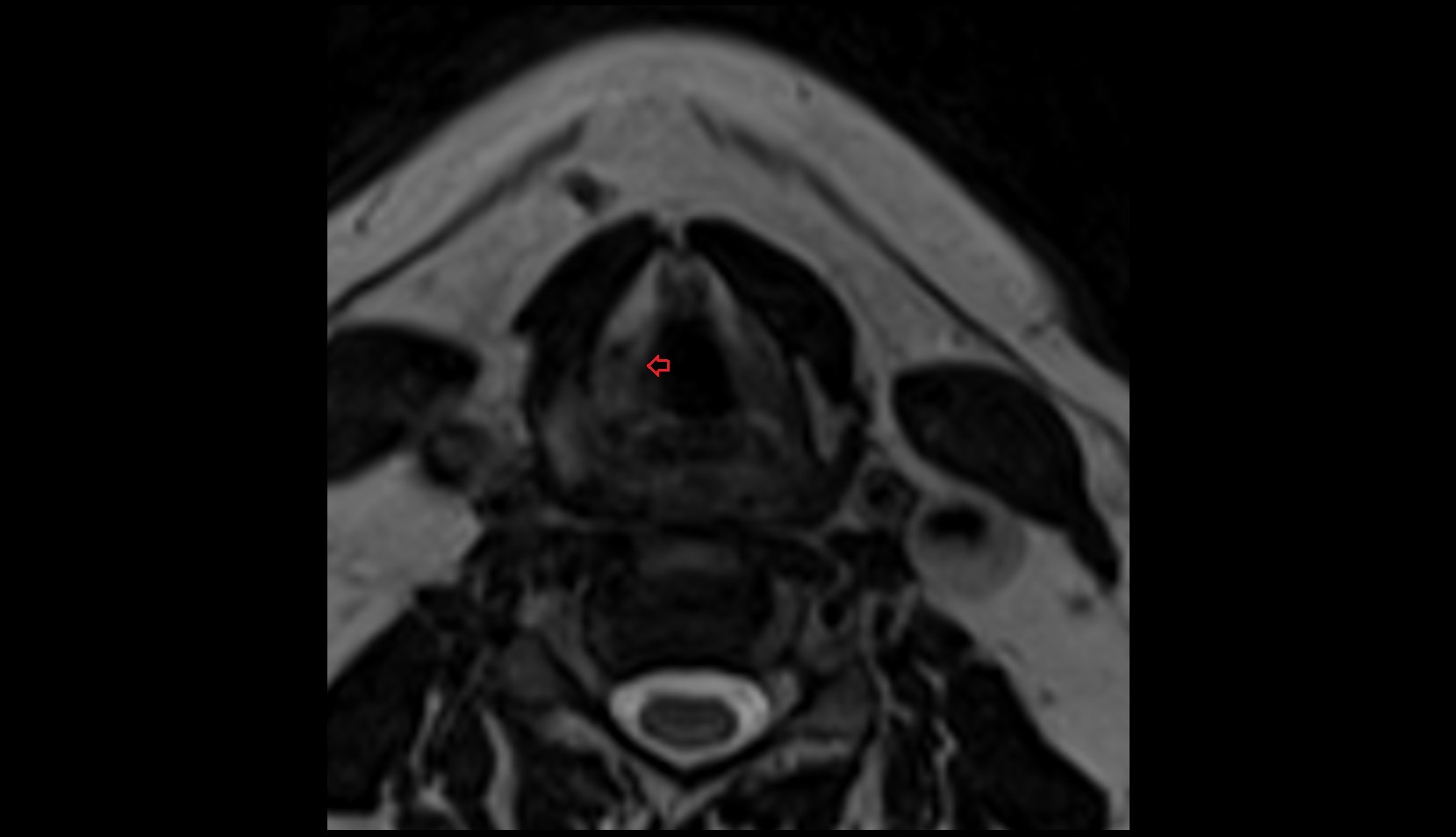Conus elasticus mri axial image