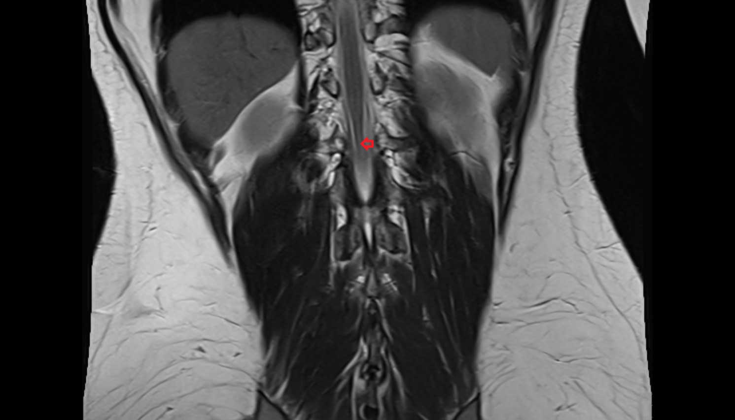 Conus medullaris MRIcoronal  anatomy  image -img-00000-00000