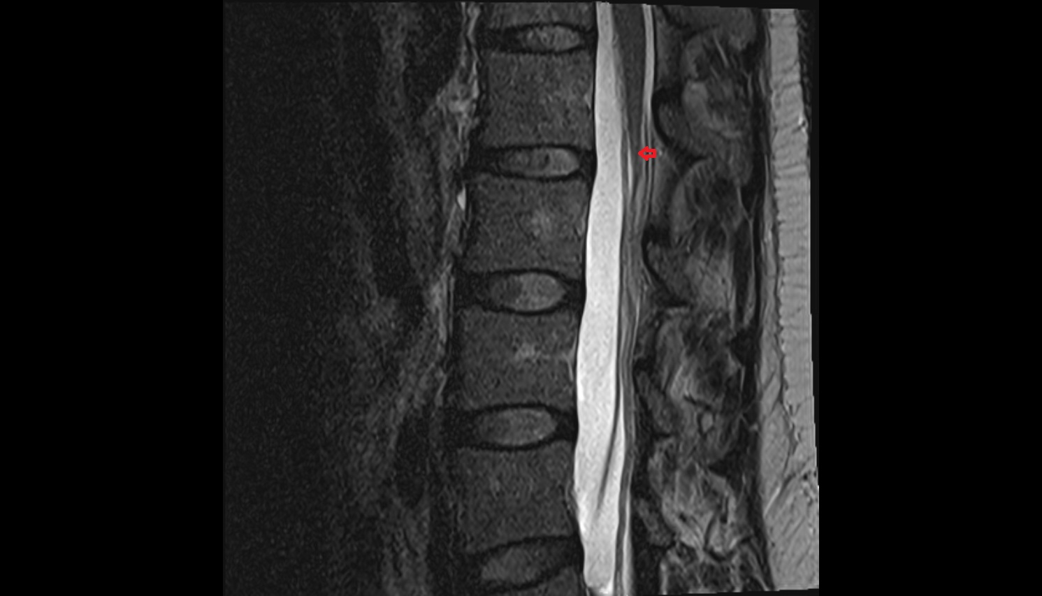 Conus medullaris MRI sagittal  anatomy  image -img-00000-00000