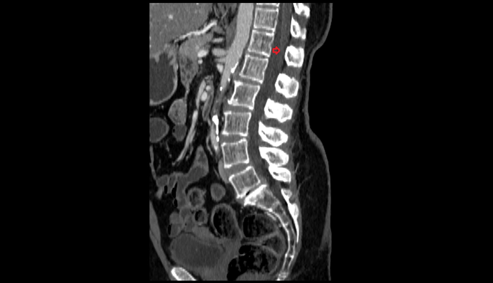 Conus medullaris ct sagittal image