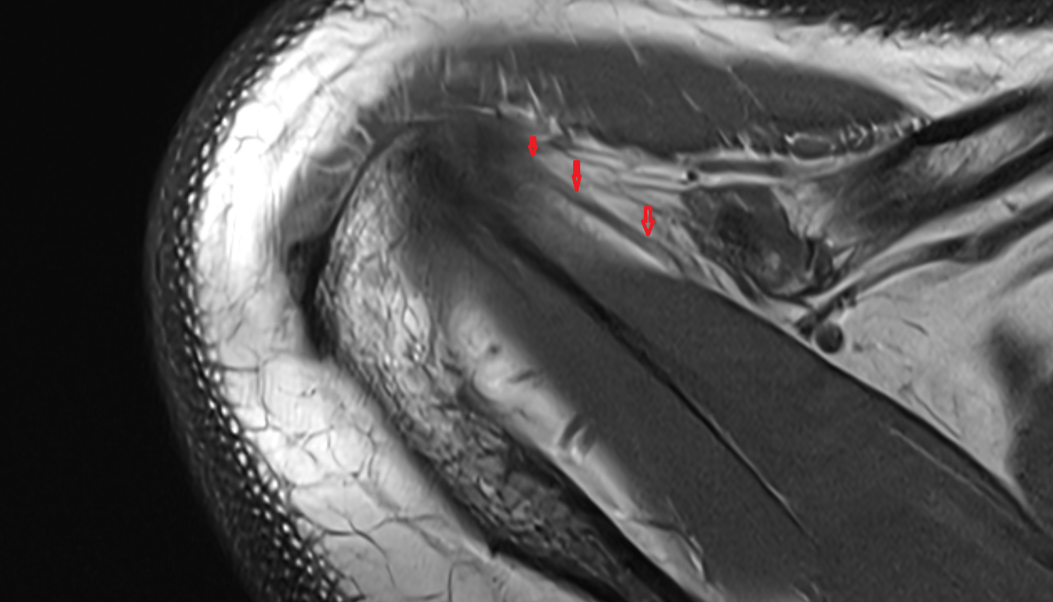 Coracoacromial ligament axial cross sectional anatomy 3T MRI AI enhanced radiology image-img-00000-00000