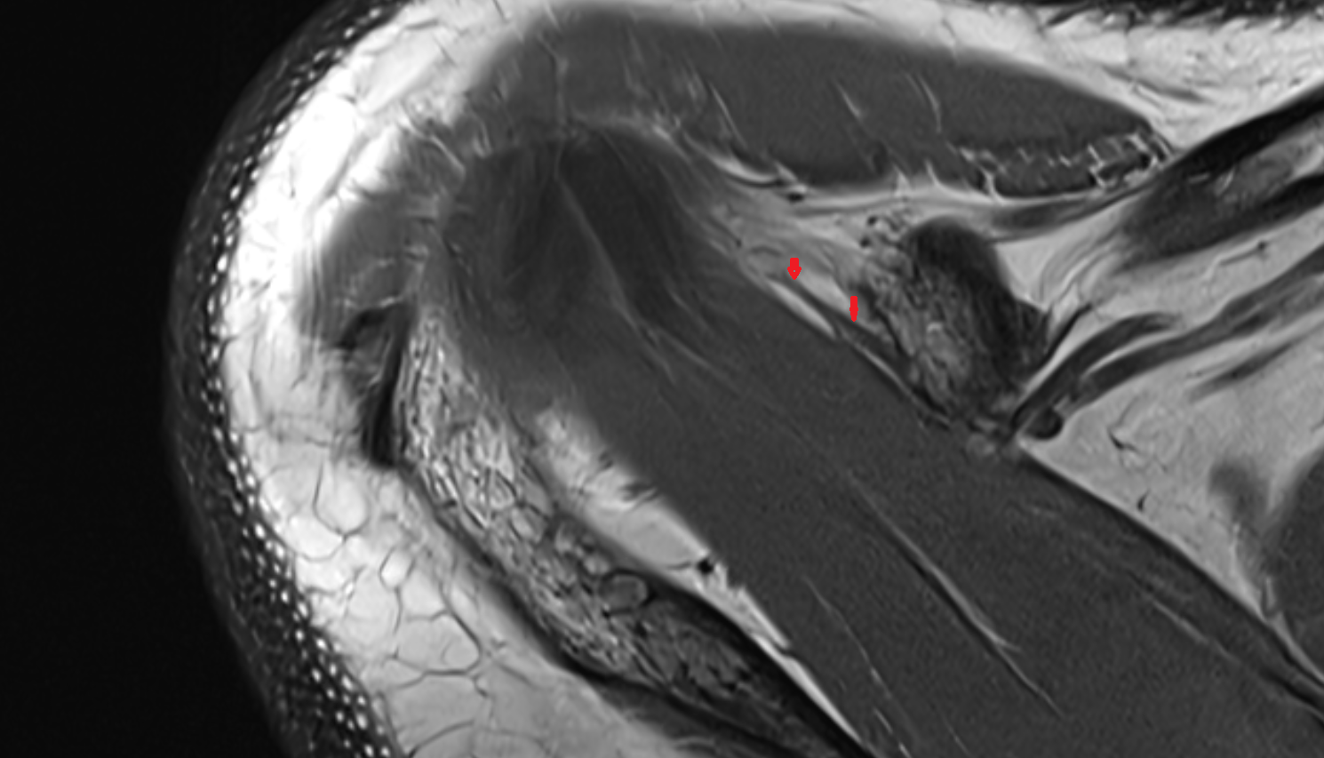 Coracoacromial ligament axial cross sectional anatomy 3T MRI AI enhanced radiology image-img-00000-00000_00001