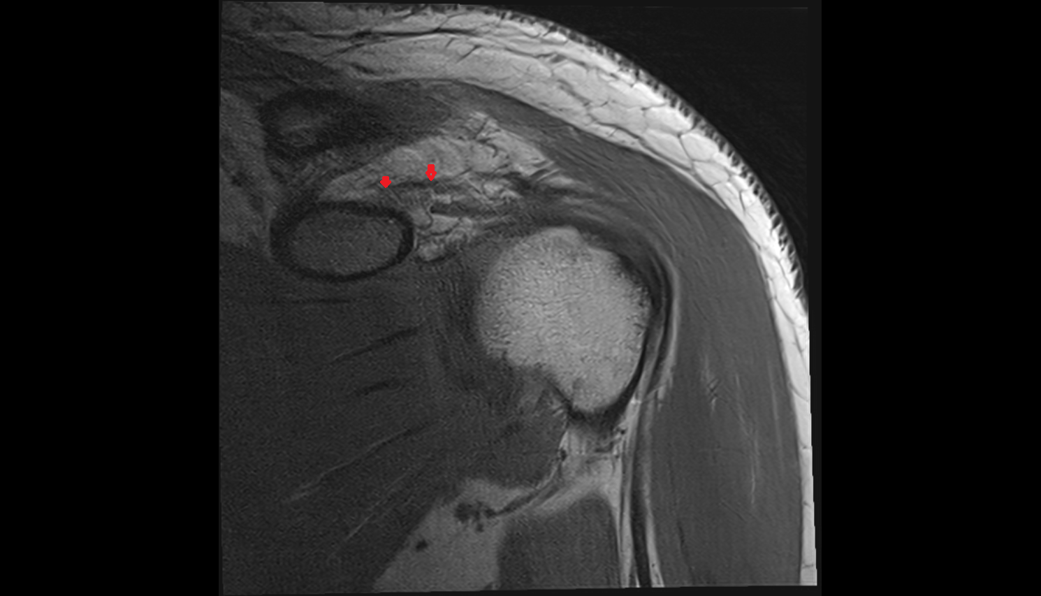 Coracoacromial ligament coronal cross sectional anatomy 3T MRI AI enhanced radiology image-img-00000-00000