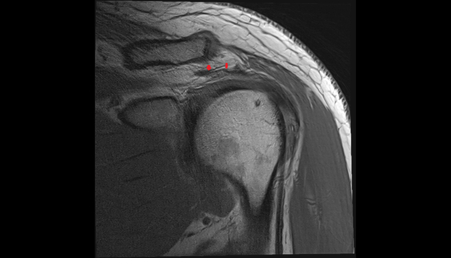 Coracoacromial ligament coronal cross sectional anatomy 3T MRI AI enhanced radiology image-img-00000-00000_00001