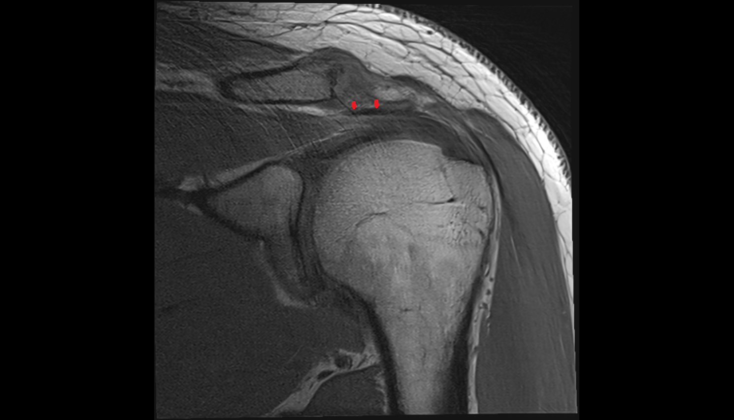 Coracoacromial ligament coronal cross sectional anatomy 3T MRI AI enhanced radiology image-img-00000-00000_00002