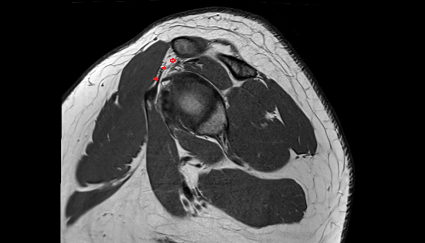 Coracoacromial ligament sag  cross sectional anatomy 3T MRI AI enhanced radiology image-img-00000-00000
