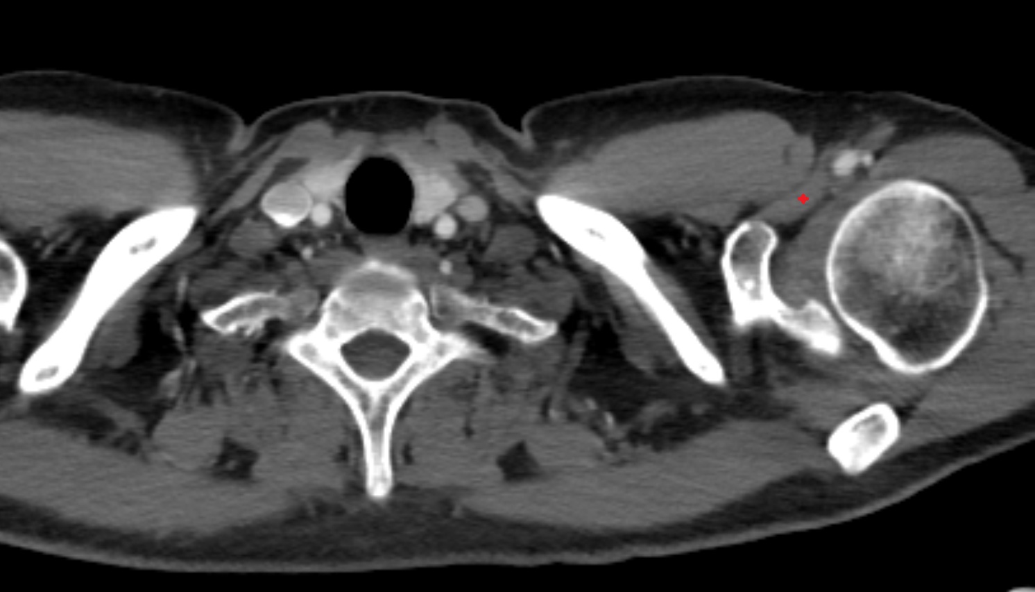 Coracobrachialis muscle  anatomy ct coronal  image -img-00000-00000