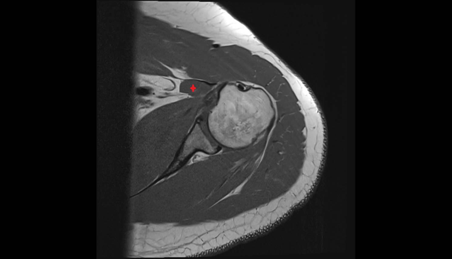 Coracobrachialis muscle  axial cross sectional anatomy 3T MRI AI enhanced radiology image-img-00000-00000
