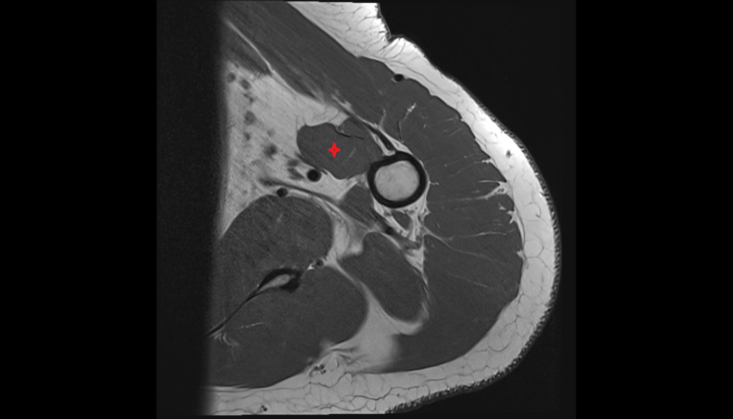 Coracobrachialis muscle  axial cross sectional anatomy 3T MRI AI enhanced radiology image-img-00000-00000_00001