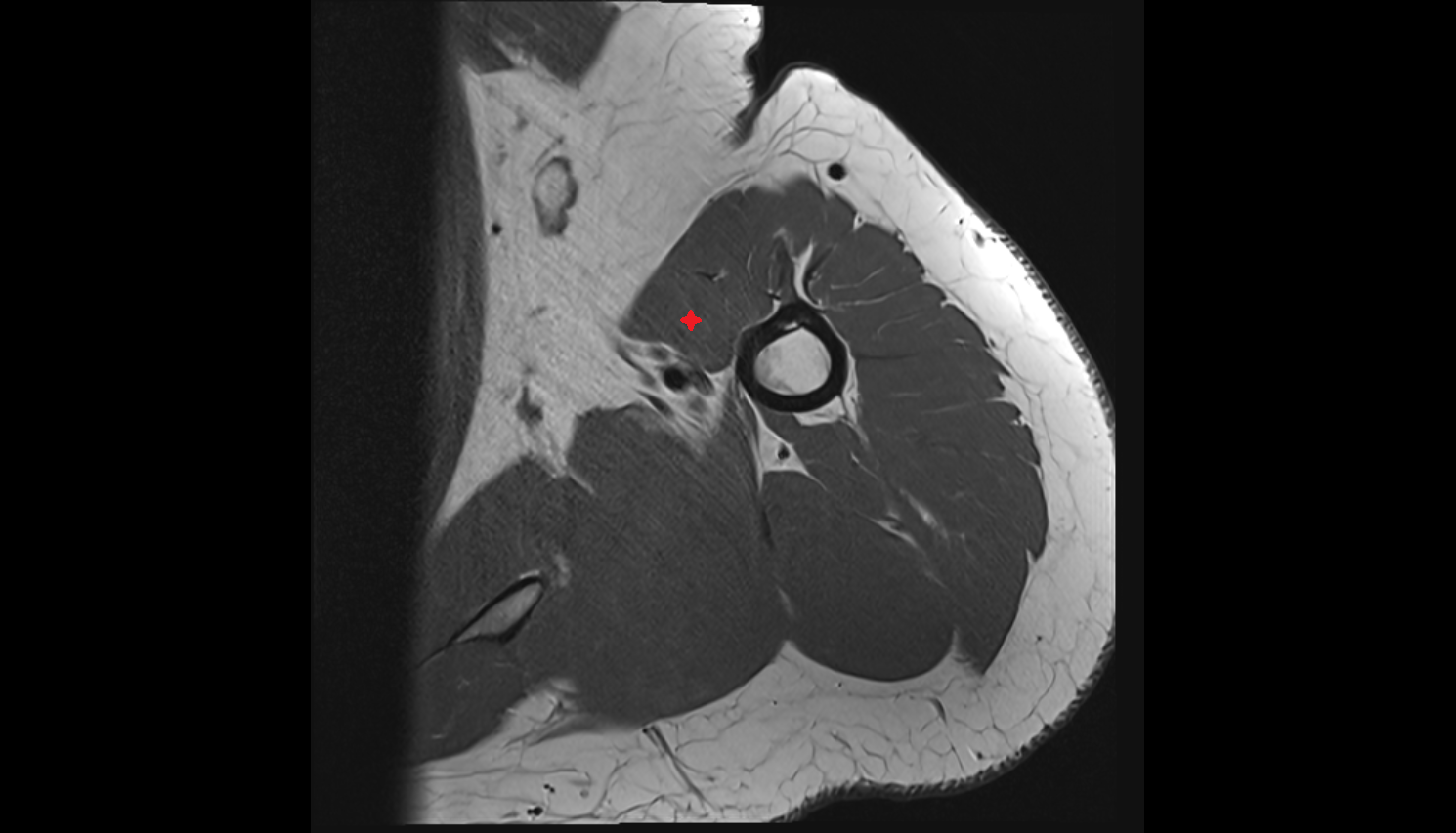 Coracobrachialis muscle  axial cross sectional anatomy 3T MRI AI enhanced radiology image-img-00000-00000_00002