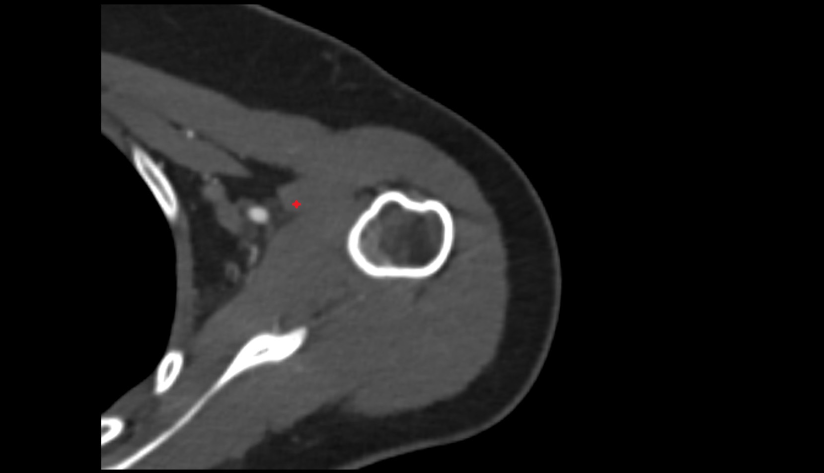 Coracobrachialis muscle ct axial