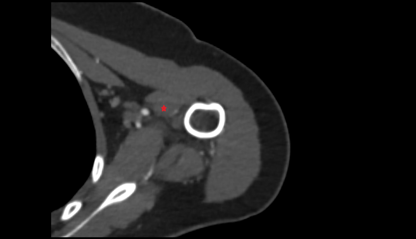 Coracobrachialis muscle ct axial 1