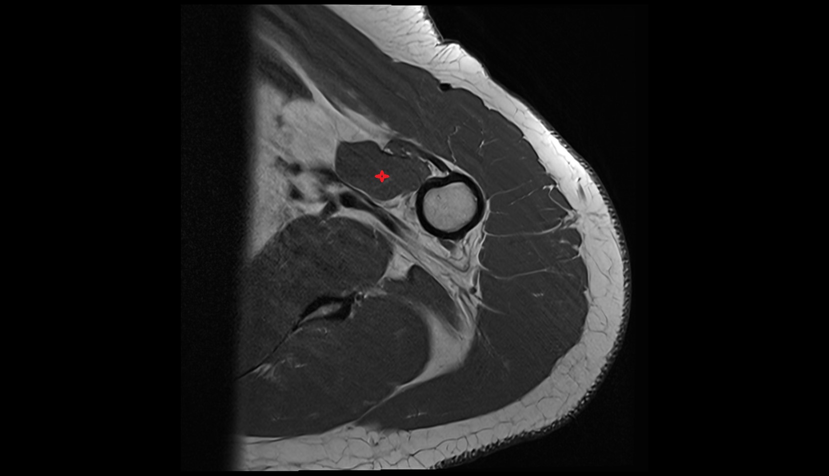 Coracobrachialis muscle mri axial image