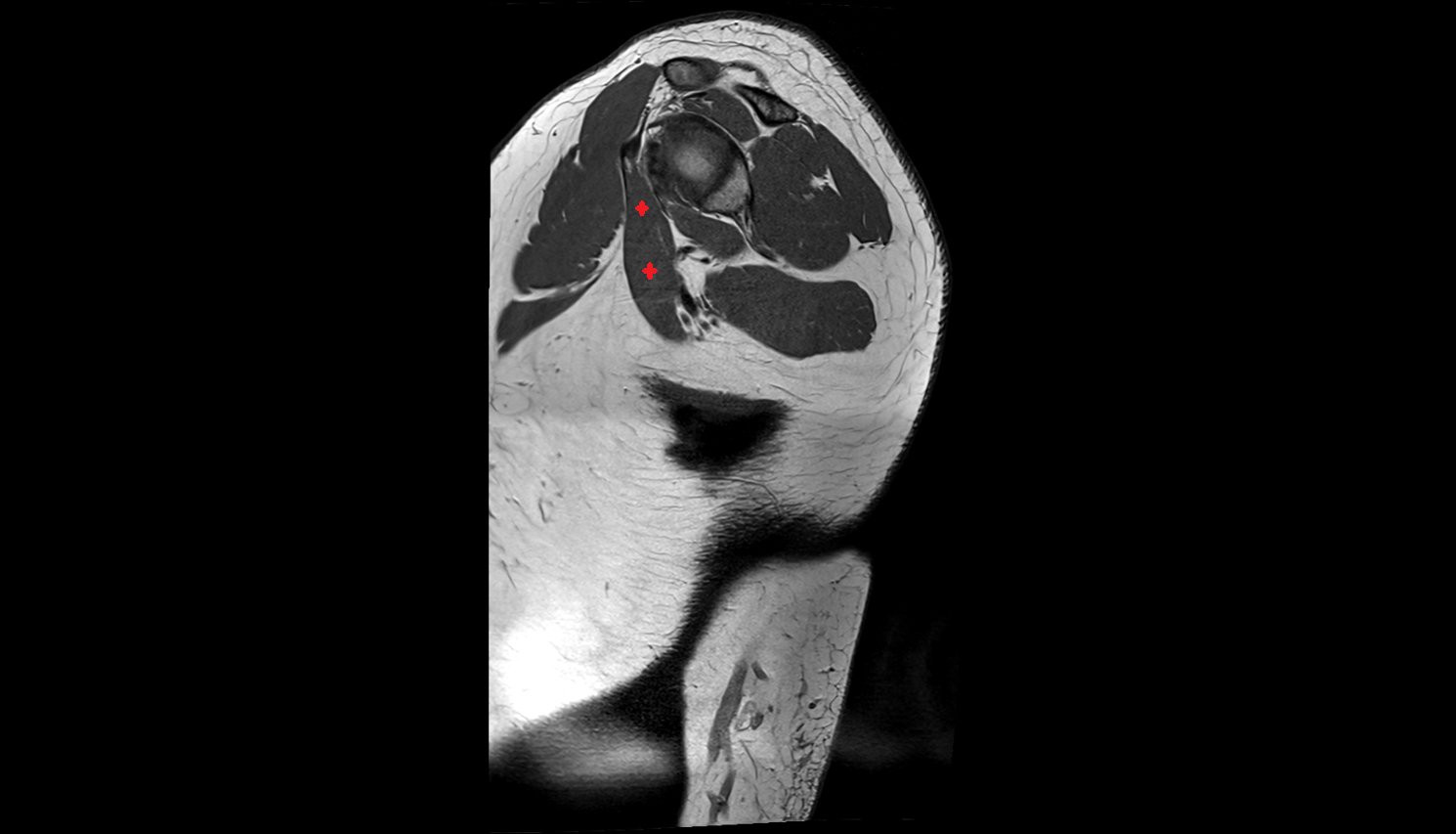 Coracobrachialis muscle  sag cross sectional anatomy 3T MRI AI enhanced radiology image-img-00000-00000