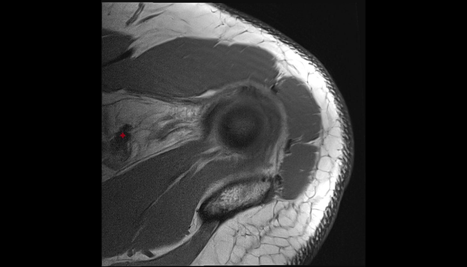 Coracoclavicular Ligaments  axial cross sectional anatomy 3T MRI AI enhanced radiology image-img-00000-00000