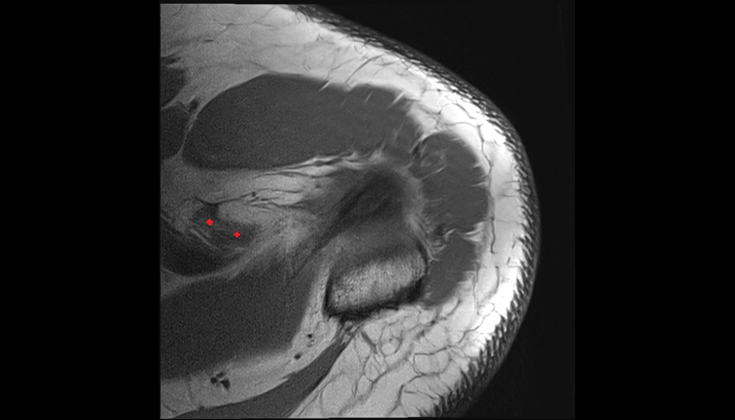 Coracoclavicular Ligaments  axial cross sectional anatomy 3T MRI AI enhanced radiology image-img-00000-00000_00001