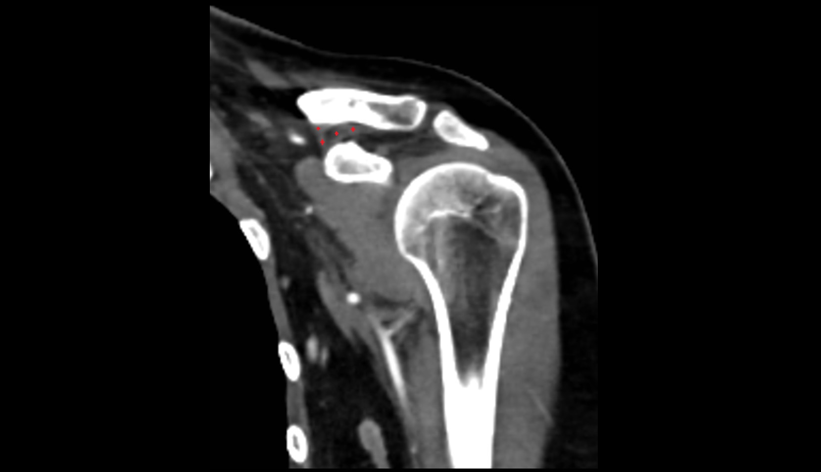 Coracoclavicular Ligaments ct coronal image