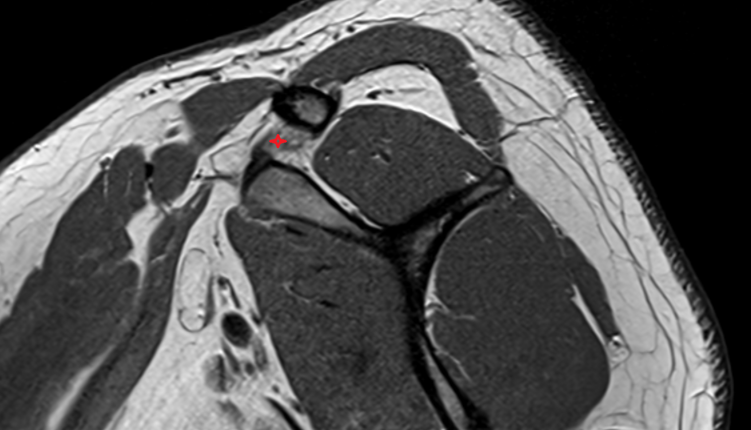 Coracoclavicular Ligaments sag  cross sectional anatomy 3T MRI AI enhanced radiology image-img-00000-00000