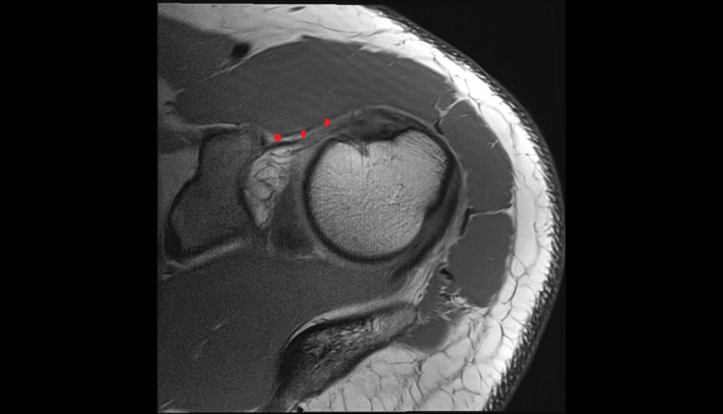 Coracohumeral ligament  axial cross sectional anatomy 3T MRI AI enhanced radiology image-img-00000-00000