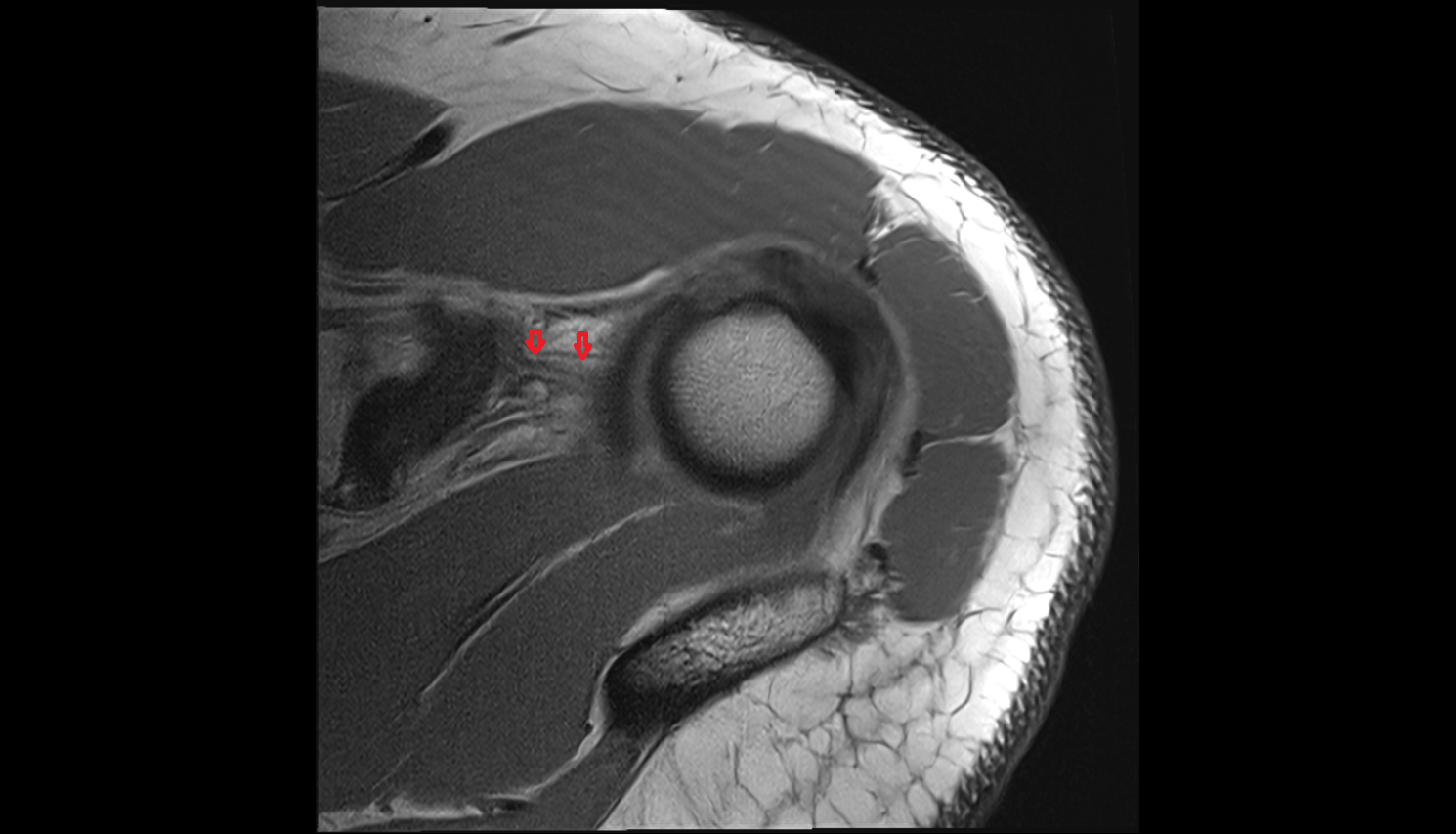 Coracohumeral ligament  axial cross sectional anatomy 3T MRI AI enhanced radiology image-img-00000-00000_00001