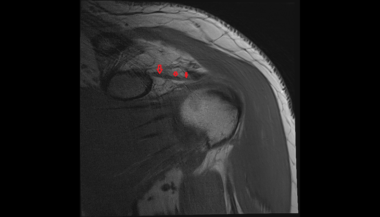Coracohumeral ligament  coronal cross sectional anatomy 3T MRI AI enhanced radiology image-img-00000-00000
