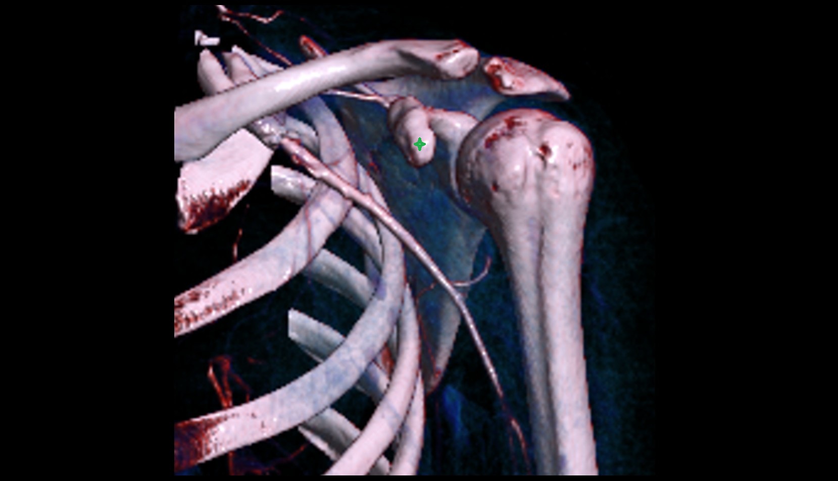 Coracoid process ct 3d image