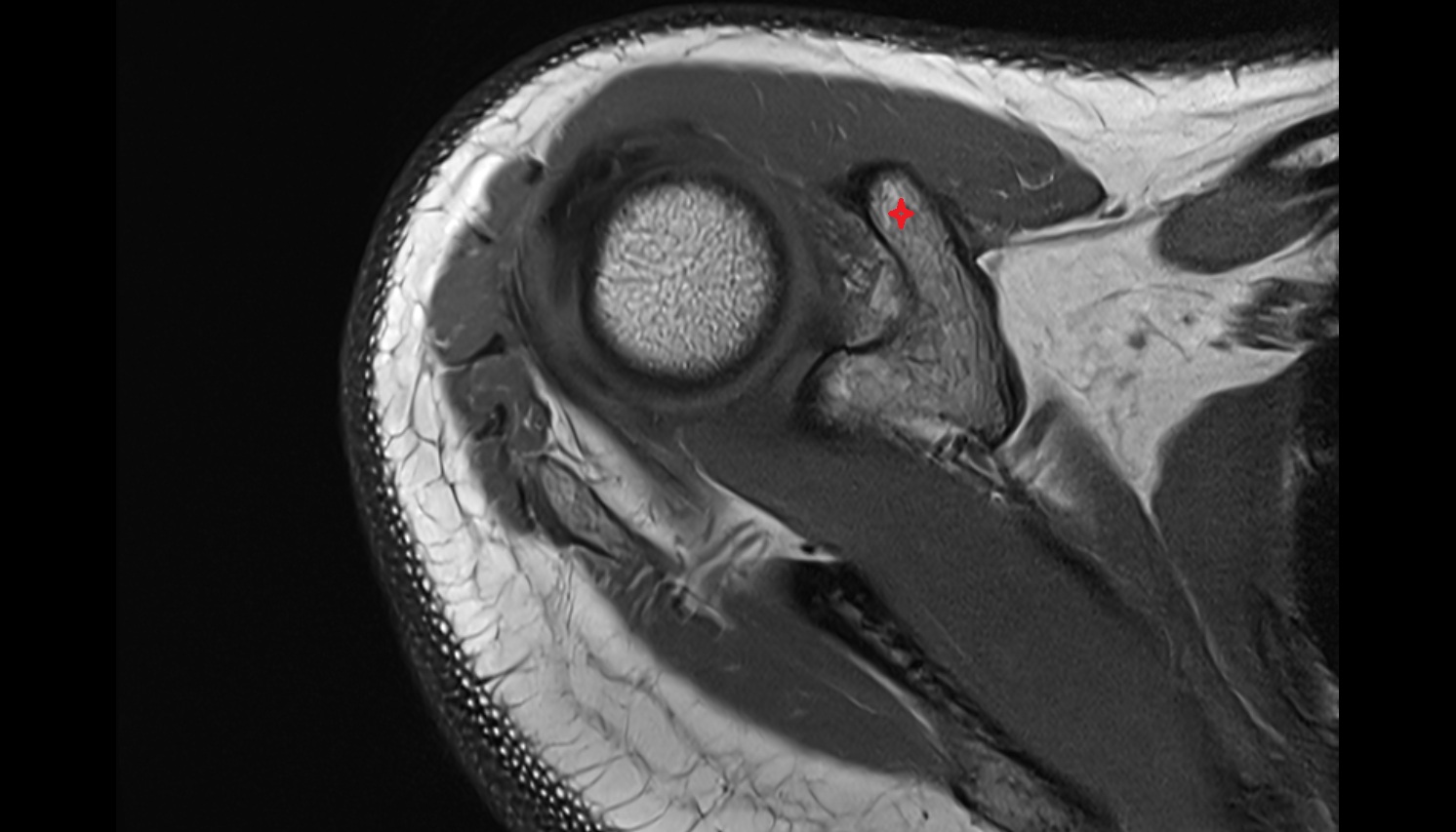 Coracoid process of scapula MRI axial  image -img-00000-00000