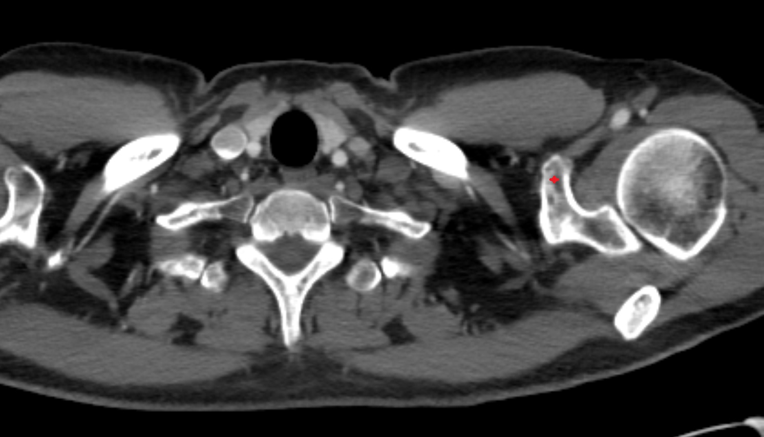 Coracoid process of scapula ct axial  image -img-00000-00000