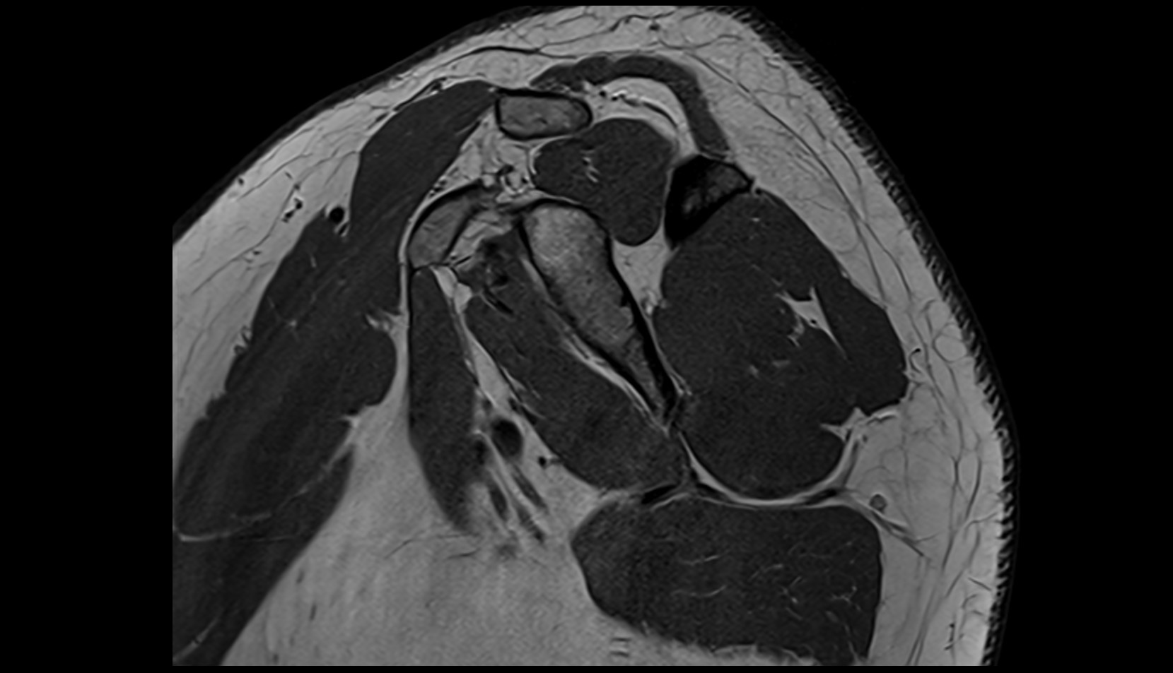 Coracoid process of scapula mri sag image