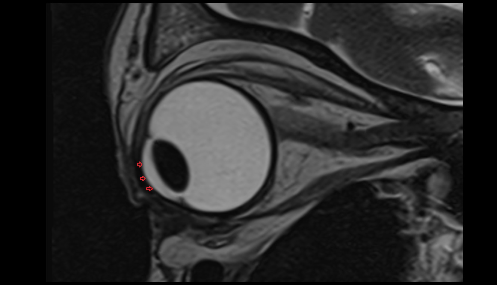 Cornea mri image