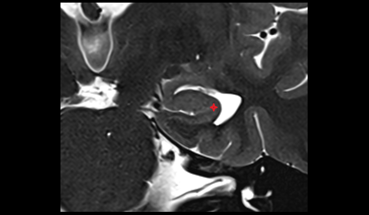 Cornu Ammonis 1 (CA 1) mri 3t coronal image