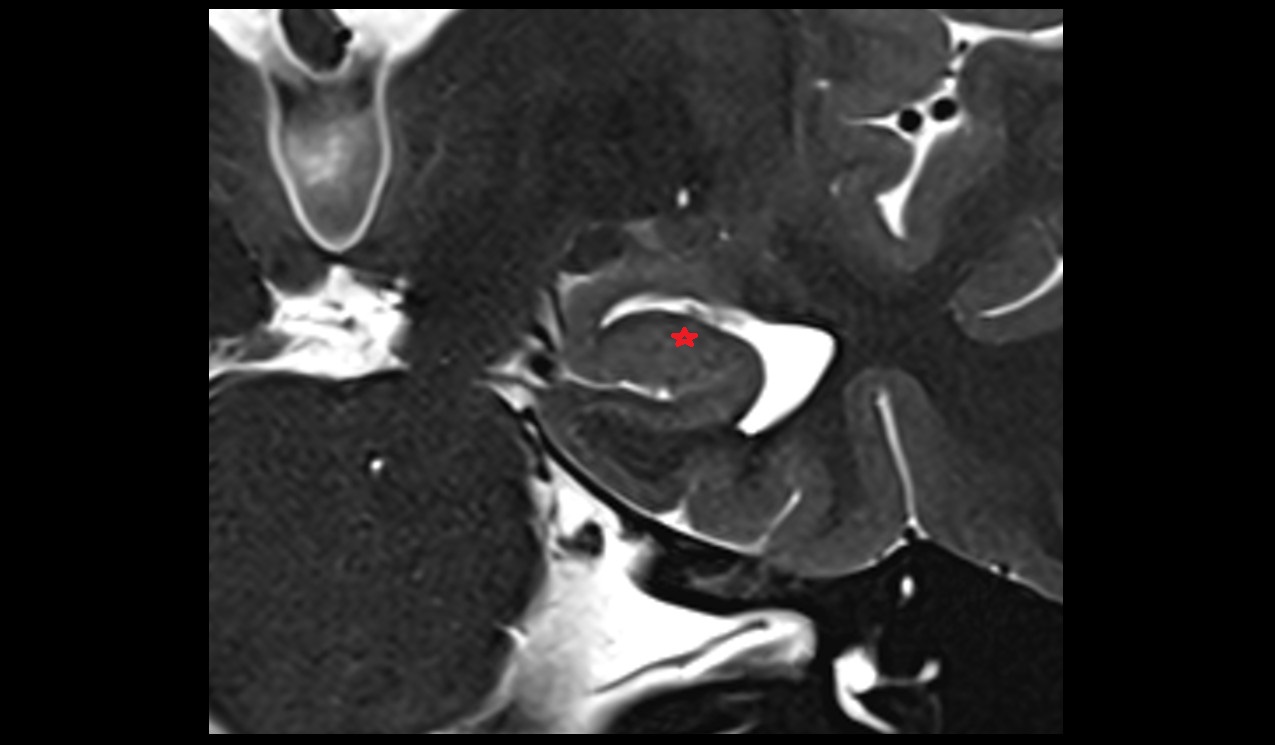 Cornu Ammonis 2 (CA 2) coronal mri 3t image
