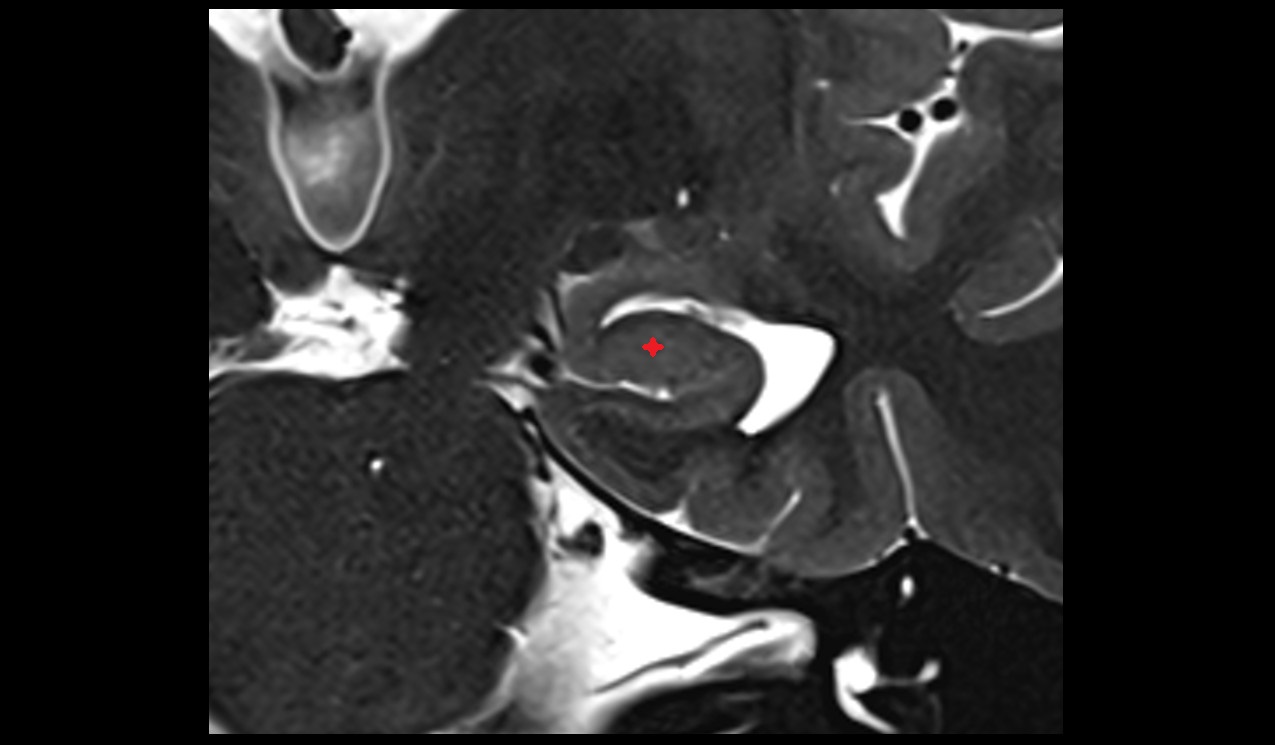Cornu Ammonis 4 (CA 4) mri 3t coronal image