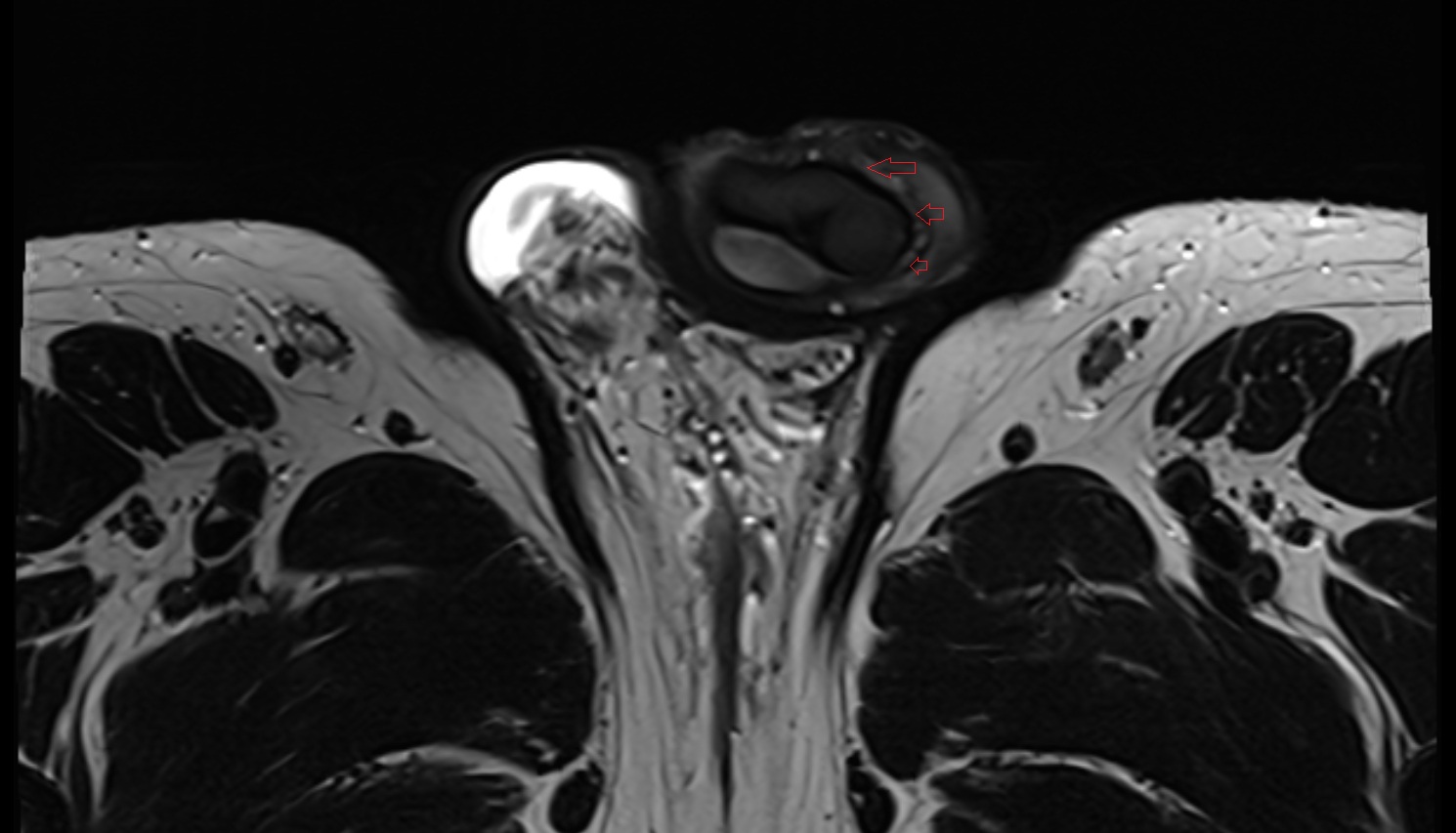 Coronal sulcus   mri  axial  anatomy  image-img-00000-00000