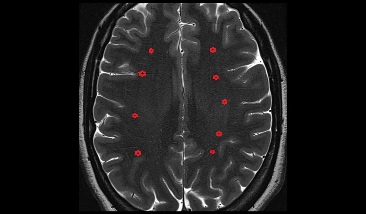 Corona radiata mri 3t axial image