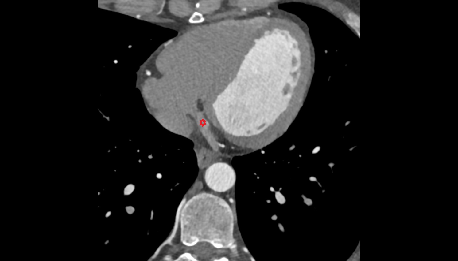 Coronary sinus anatomy  CT axial image -img-00000-00000