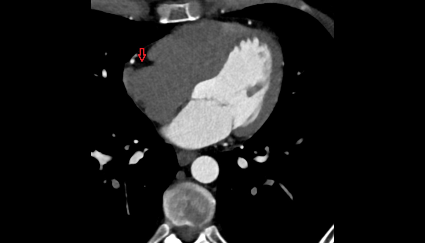 Coronary sulcus anatomy CT axial image -img-00000-00000