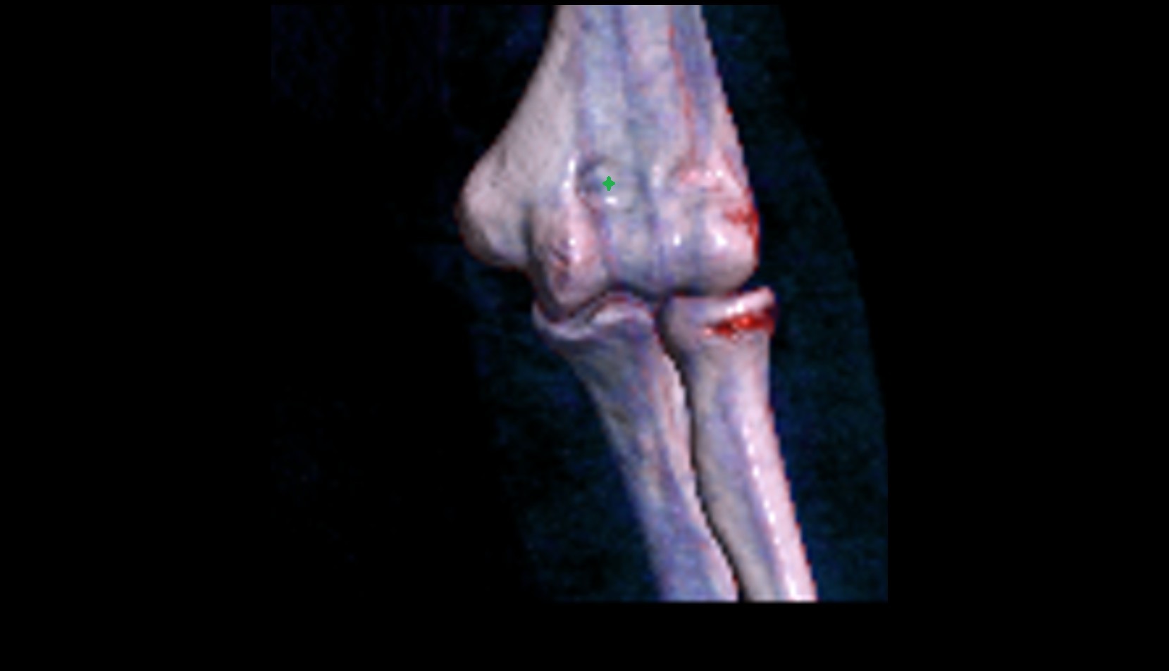 Coronoid fossa 3D VRT IMAGE