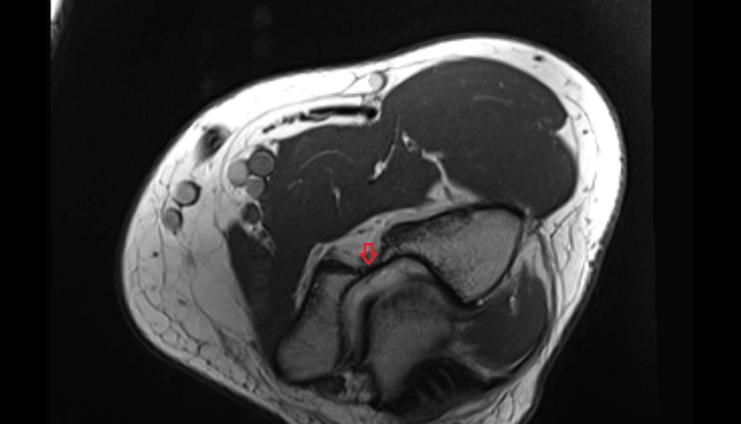 Coronoid fossa of ulna axial  cross sectional anatomy 3T MRI AI enhanced radiology image -img-00000-00000