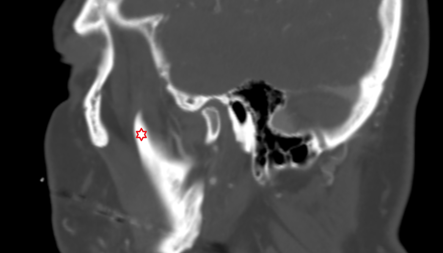 Coronoid process of mandible CT  anatomy image -img-00000-00000