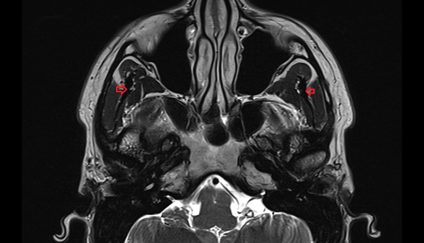 Coronoid process of mandible MRI  anatomy image -img-00000-00000