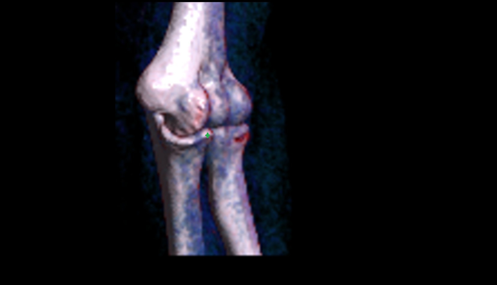 Coronoid process of ulna 3D VRT IMAGE