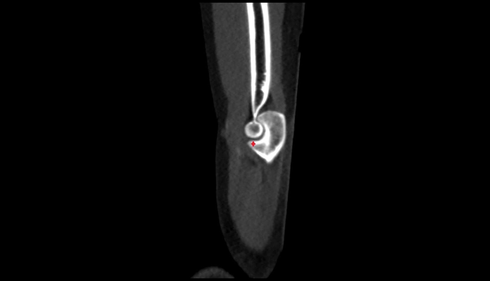 Coronoid process of ulna ct sag image